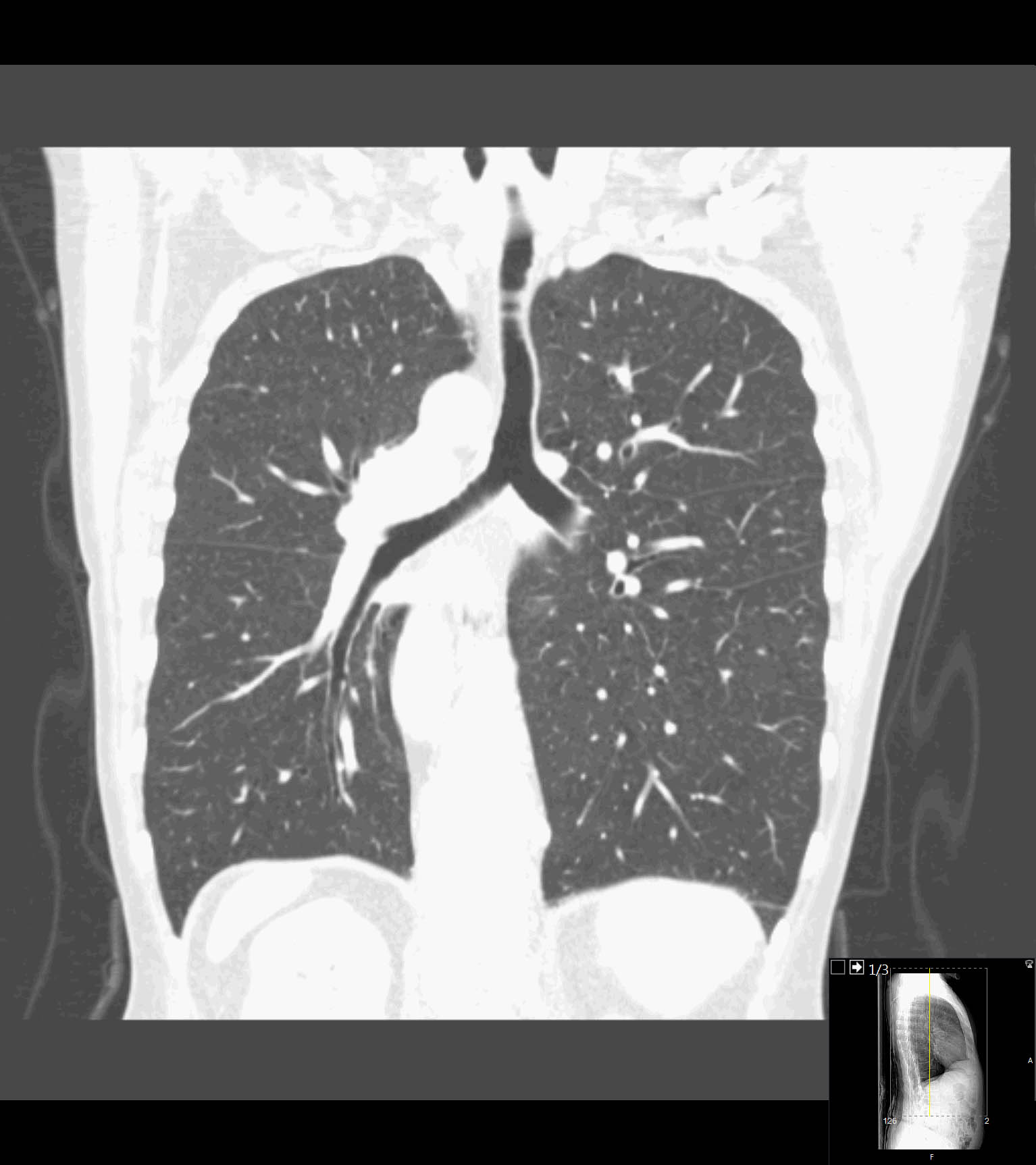 Situs inversus | Image | Radiopaedia.org