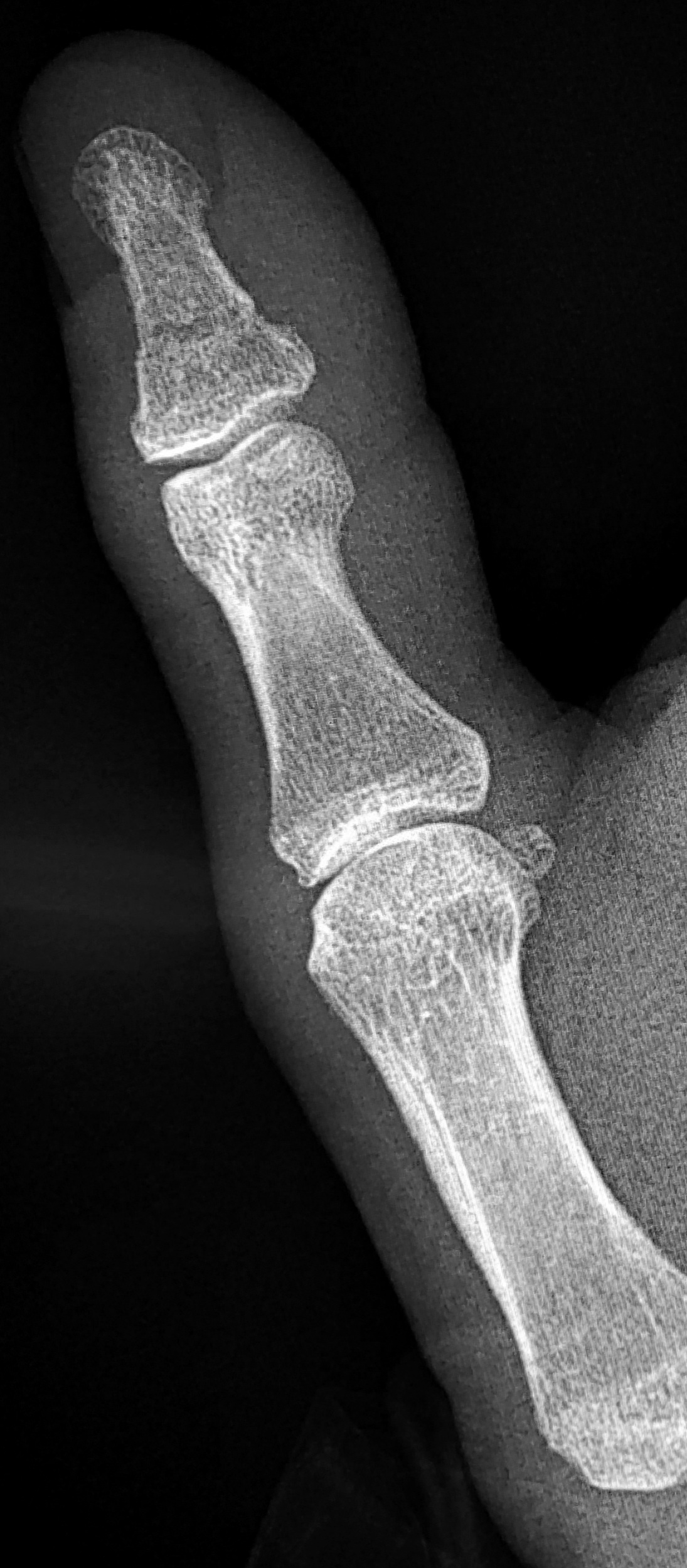 Fracture - distal phalanx of thumb | Image | Radiopaedia.org