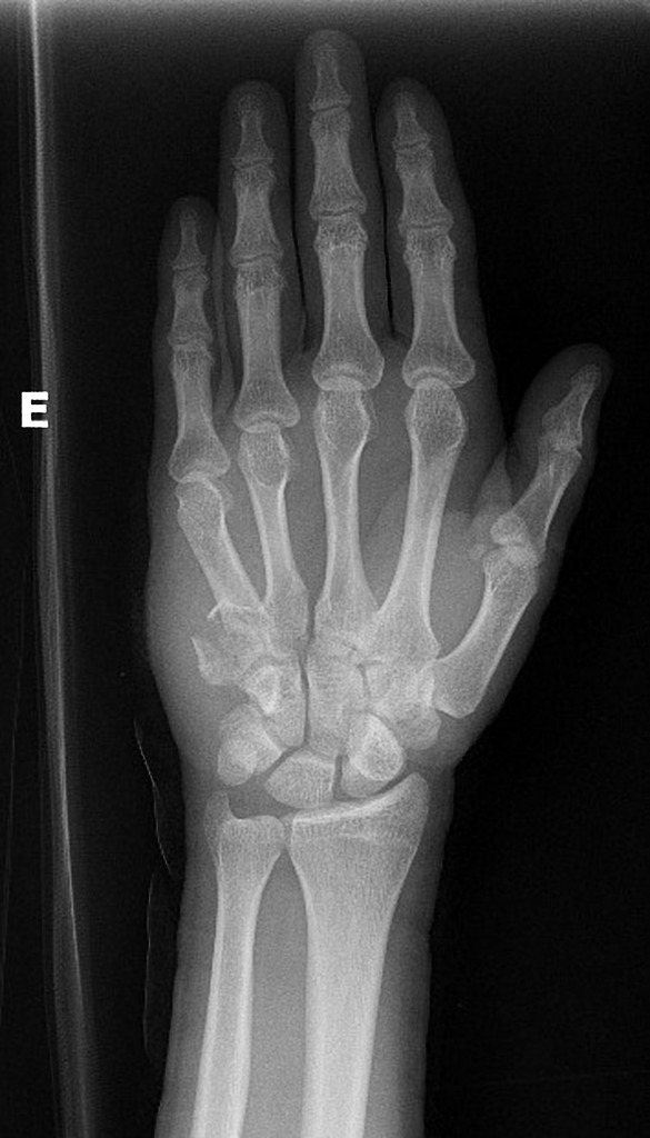 Radiology Case Bennett S Fracture