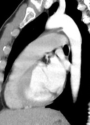 Patent Ductus Arteriosus | Radiology Case | Radiopaedia.org