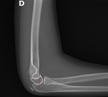 Anterior Humeral Line Radiology