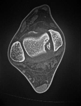 Osteochondritis dissecans of the talus | Radiology Case | Radiopaedia.org