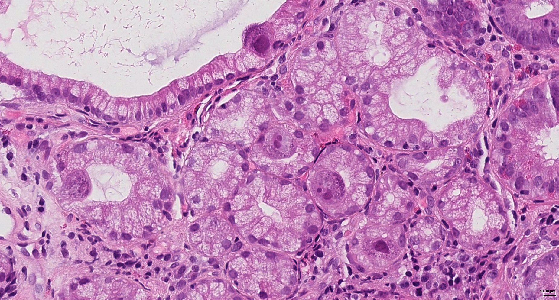 CMV duodenitis (histology) | Image | Radiopaedia.org