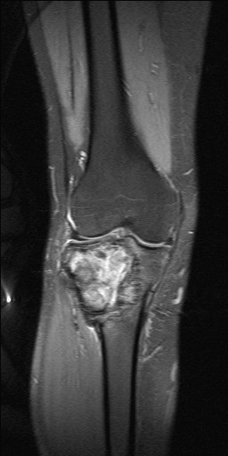 Osteoclastoma Image Radiopaedia Org