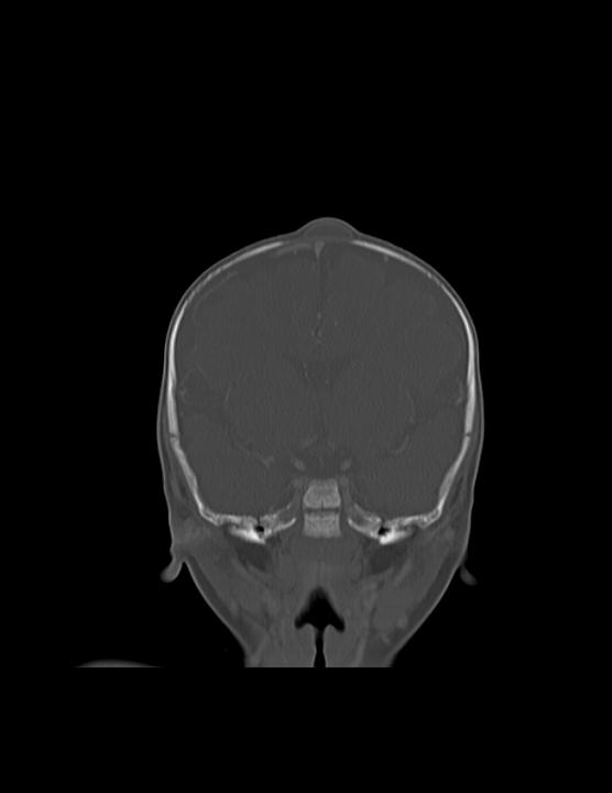 Anterior Fontanelle Dermoid Cyst Image 4091