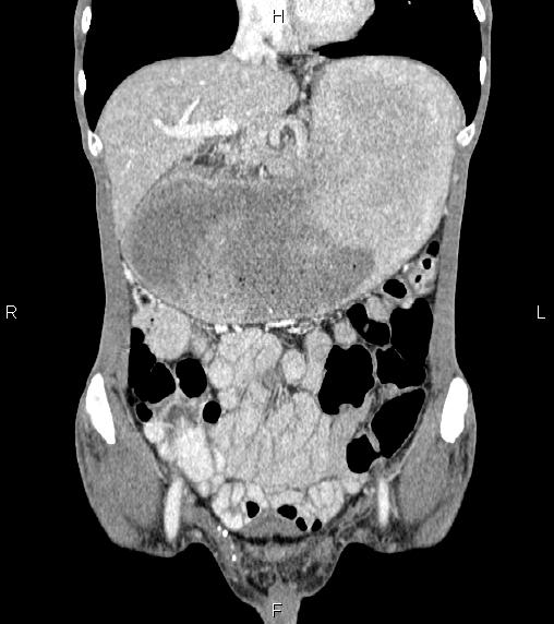 Gastric Outlet Obstruction From Gastric Adenocarcinoma Image 9507