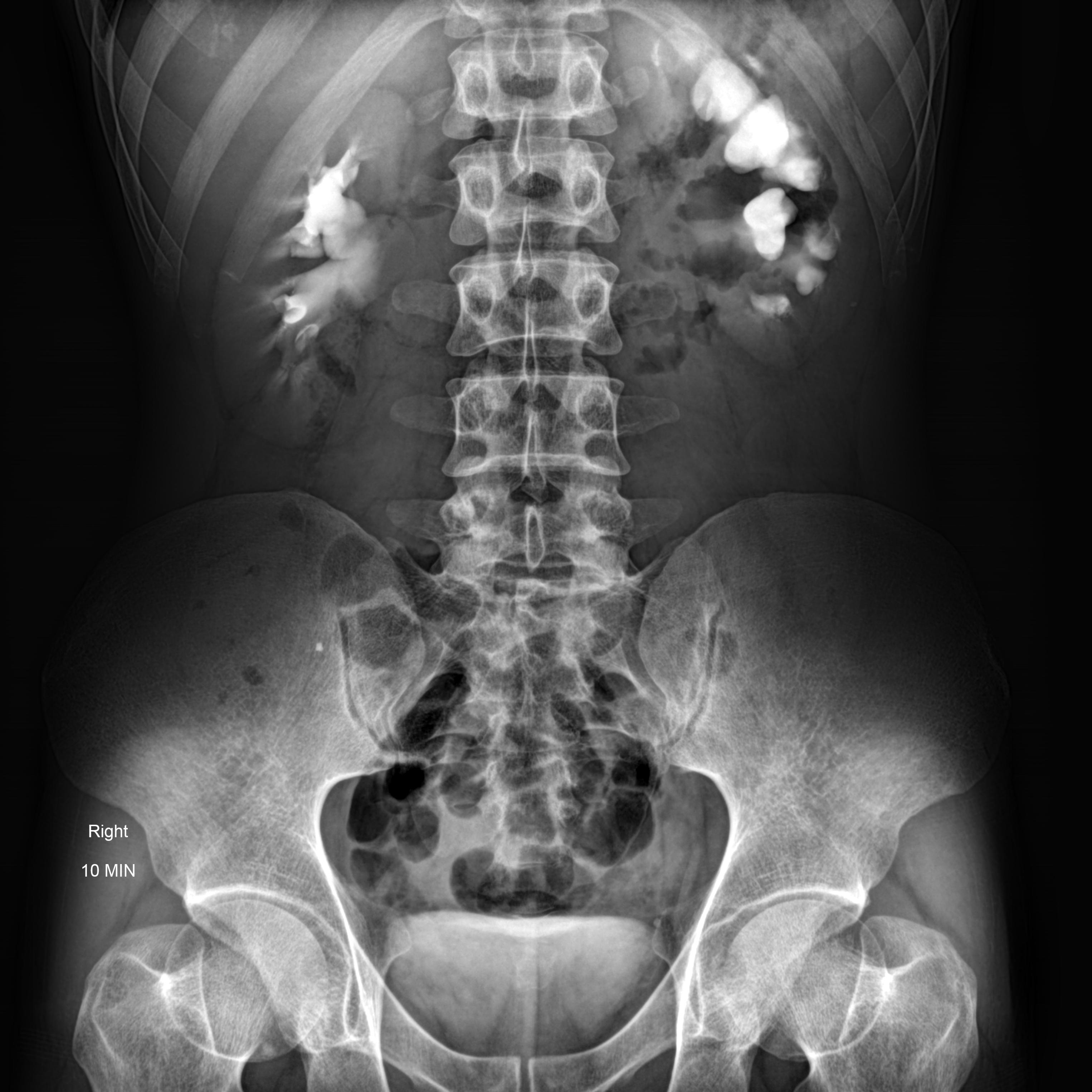 Bilateral Ureteropelvic Junction Obstruction | Image | Radiopaedia.org