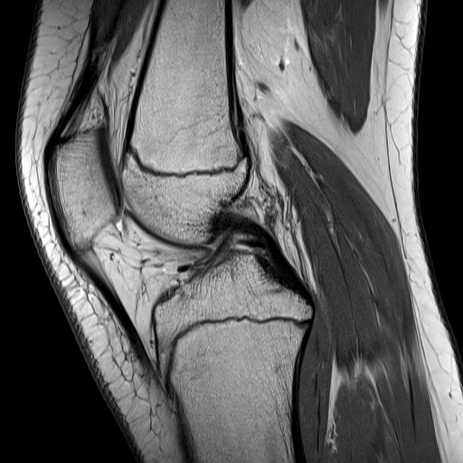 Normal MRI knee - 14-year-old | Image | Radiopaedia.org