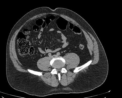 Obstructive Uropathy With Delayed Nephrogram | Image | Radiopaedia.org