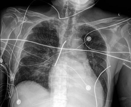 Retained guidewire | Radiology Case | Radiopaedia.org