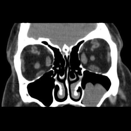 Graves ophthalmopathy | Radiology Case | Radiopaedia.org