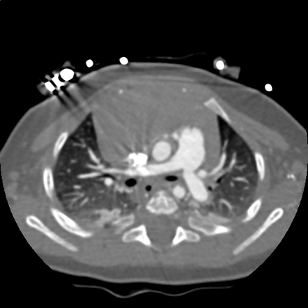 Anomalous right coronary artery from the pulmonary artery | Radiology ...