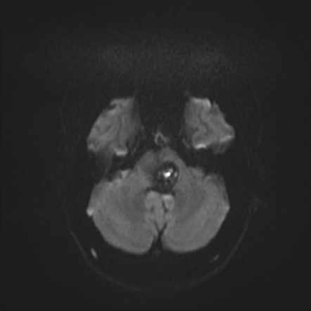 Pontine and cerebral cavernomas | Image | Radiopaedia.org