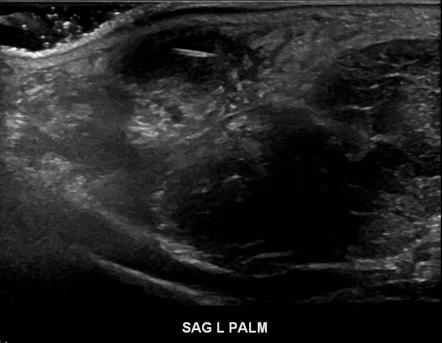 Thenar space abscess | Radiology Case | Radiopaedia.org