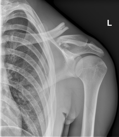 Clavicular fracture | Radiology Case | Radiopaedia.org