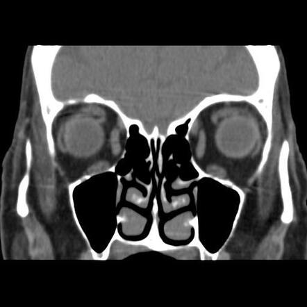 Hemorrhagic dacryocystitis | Image | Radiopaedia.org