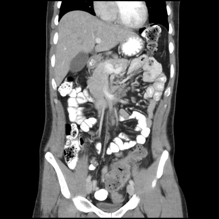 Sigmoid colon cancer | Image | Radiopaedia.org