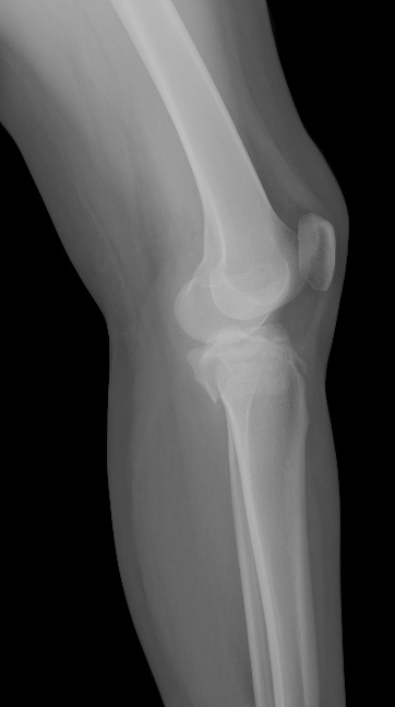 Tibial Plateau Fracture Schatzker Type Iv Image