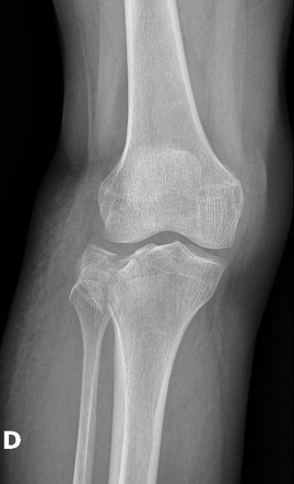 Tibial plateau fracture - Schatzker type II | Radiology Case ...