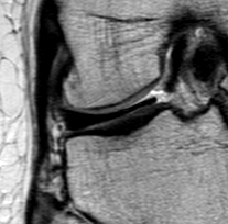 Discoid meniscus | Image | Radiopaedia.org