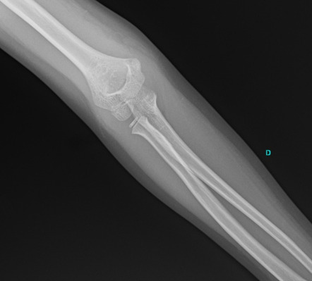 Supracondylar fracture - Gartland type II | Image | Radiopaedia.org