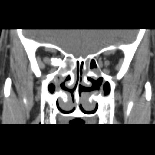 Ethmoid Sinus Osteoma Image