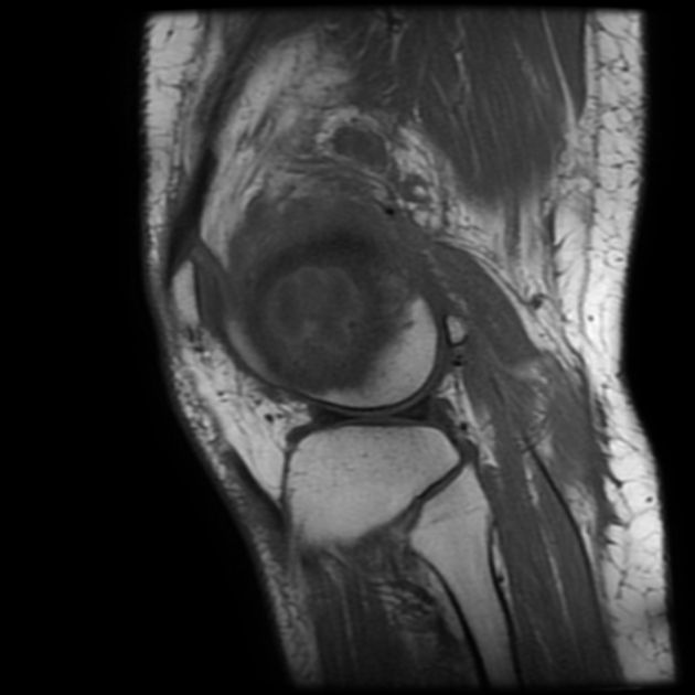 Brodie abscess Radiology Reference Article Radiopaedia