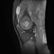 Brodie s abscess with penumbra sign Radiology Case Radiopaedia