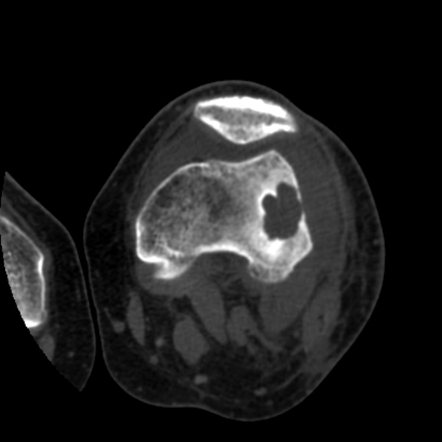 Brodie's abscess with penumbra sign | Image | Radiopaedia.org