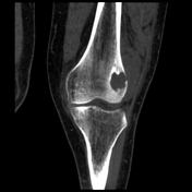 Brodie s abscess with penumbra sign Radiology Case Radiopaedia