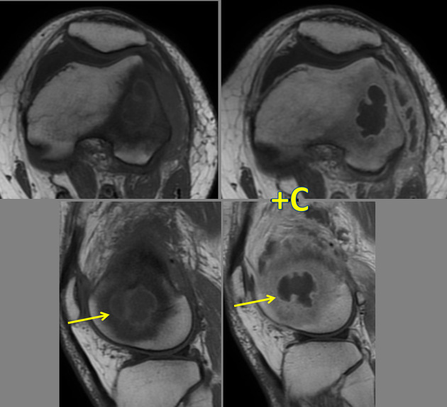 Brodie s abscess with penumbra sign Radiology Case Radiopaedia