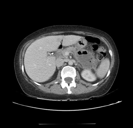 Acute pancreatitis - Balthazar E - post ERCP | Radiology Case ...