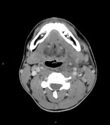 Lemierre syndrome | Radiology Reference Article | Radiopaedia.org