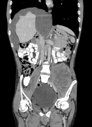 Abdominopelvic neurofibromatosis with malignant peripheral nerve sheath ...