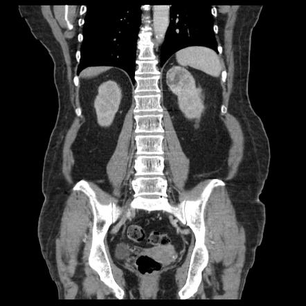 How Can The Renal Nephrometry Scoring System Aid