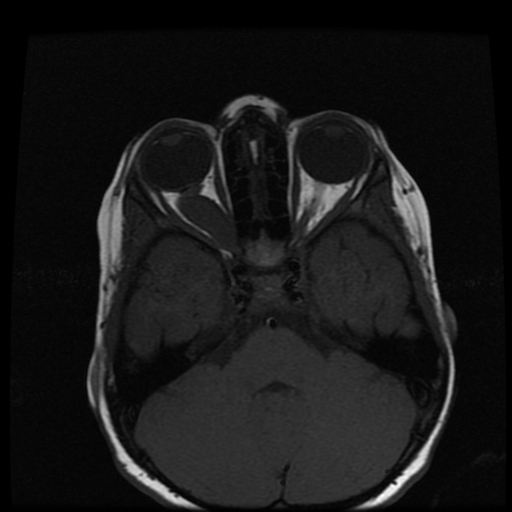 optic-nerve-glioma-image-radiopaedia