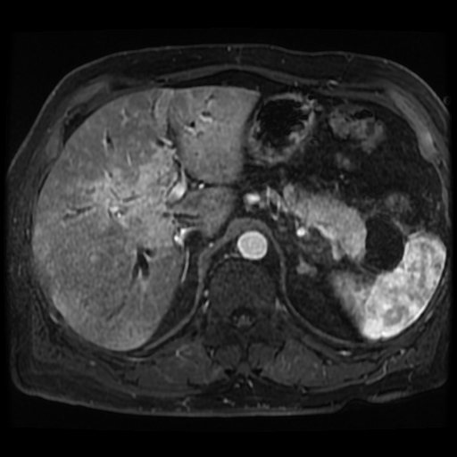 File:IgG4-related autoimmune cholangitis, pancreatitis, and pseudotumor ...