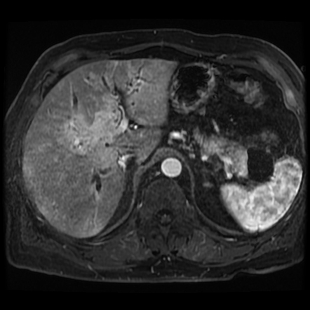 IgG4-related autoimmune cholangitis, pancreatitis, and pseudotumour ...