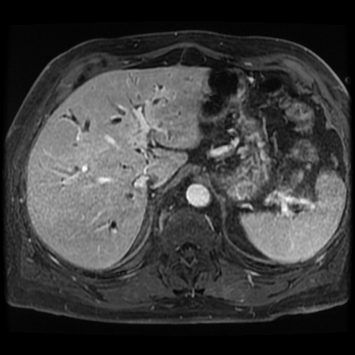 File:IgG4-related autoimmune cholangitis, pancreatitis, and pseudotumor ...