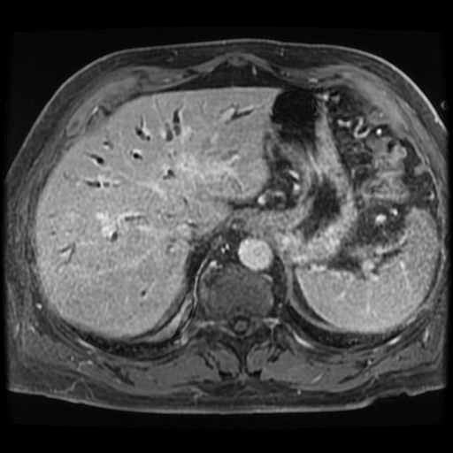 File:IgG4-related autoimmune cholangitis, pancreatitis, and pseudotumor ...