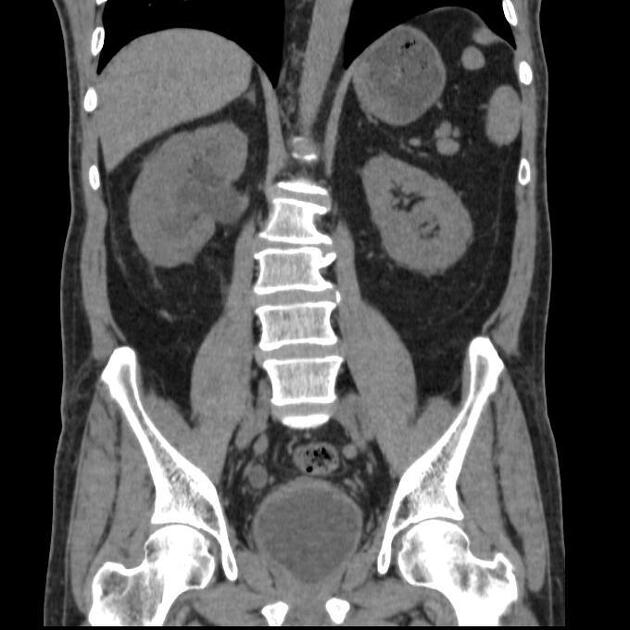 Hydronephrosis | Radiology Reference Article | Radiopaedia.org