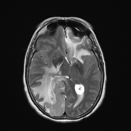 AIDS-related Diffuse Large B-cell Lymphoma - CNS | Radiology Case ...