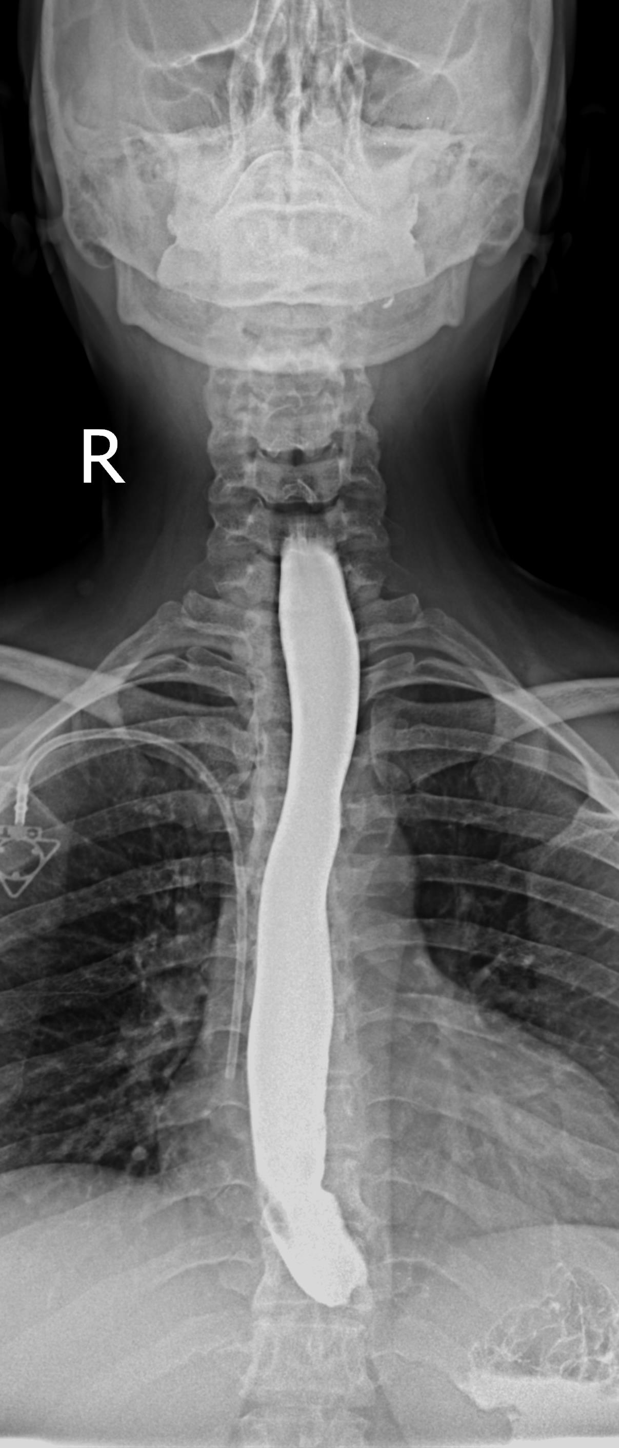 Gastric cardia cancer invading the distal esophagus (barium swallow ...