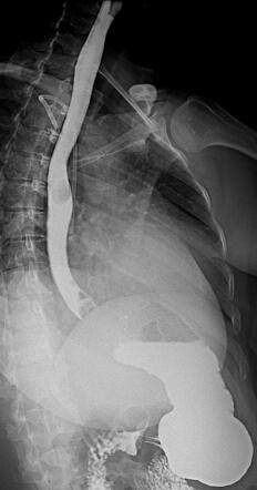 Gastric Cardia Cancer Invading The Distal Esophagus Barium Swallow