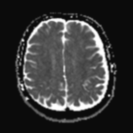 Cerebral microhemorrhage with SWI dipole | Image | Radiopaedia.org