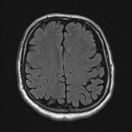 Cerebral microhemorrhage with SWI dipole | Image | Radiopaedia.org