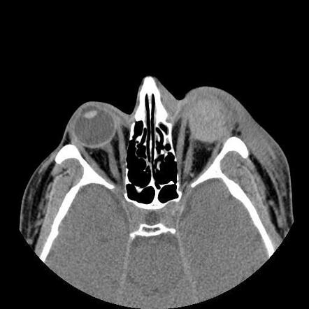 postoperative hemorrhage of the eye icd 10