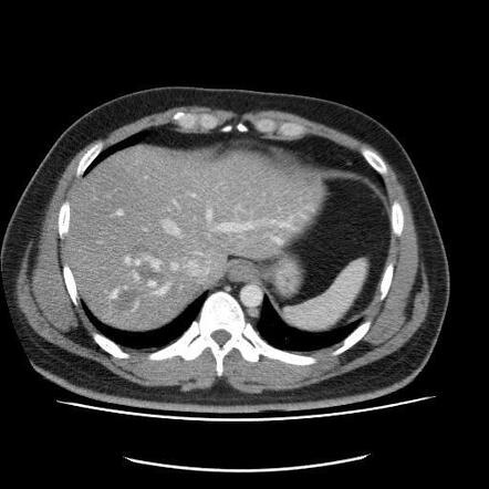 Liver hemangioma | Radiology Case | Radiopaedia.org