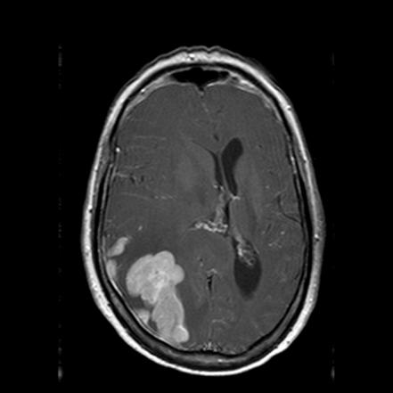 Lymphomas of the central nervous system | Radiology Reference Article ...