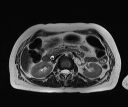 Acute pancreatitis - Balthazar E - post ERCP | Image | Radiopaedia.org